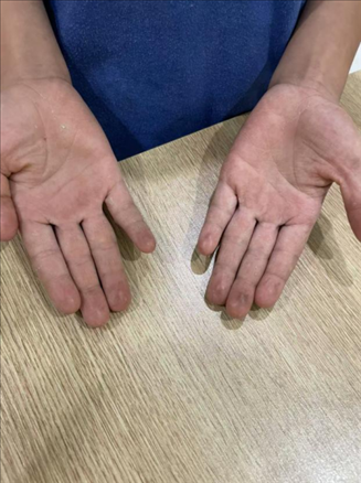 9歲小學(xué)生長(zhǎng)期拍煙卡，手部粗糙長(zhǎng)繭。受訪者供圖